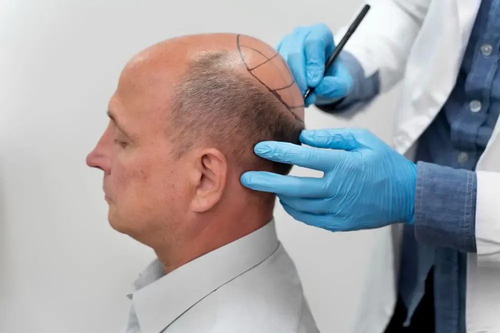 What are hair transplants and how are they performed?