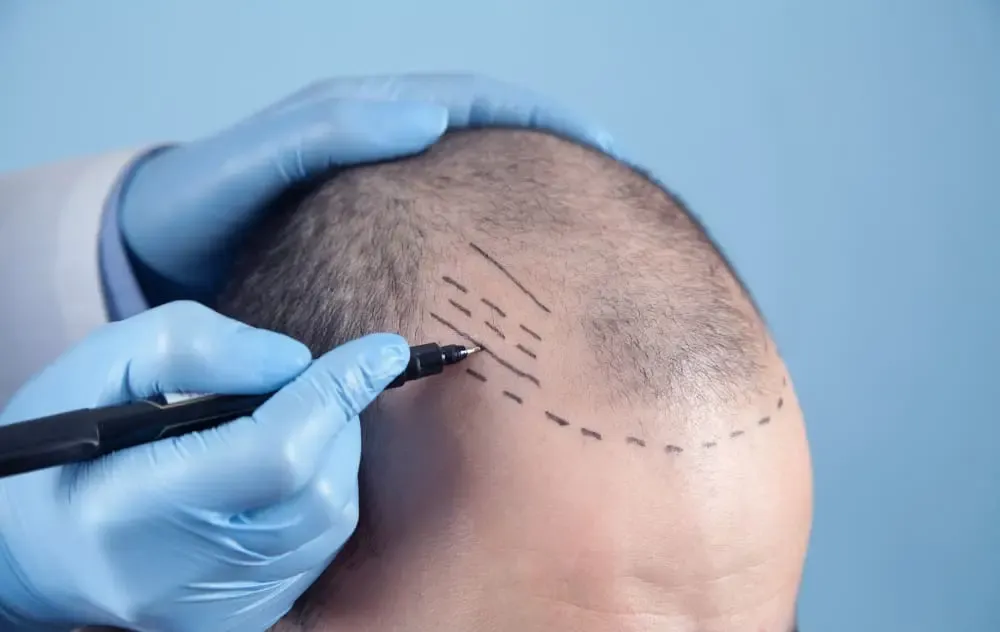 FUE Hair Transplant: What is it and who is it suitable for?