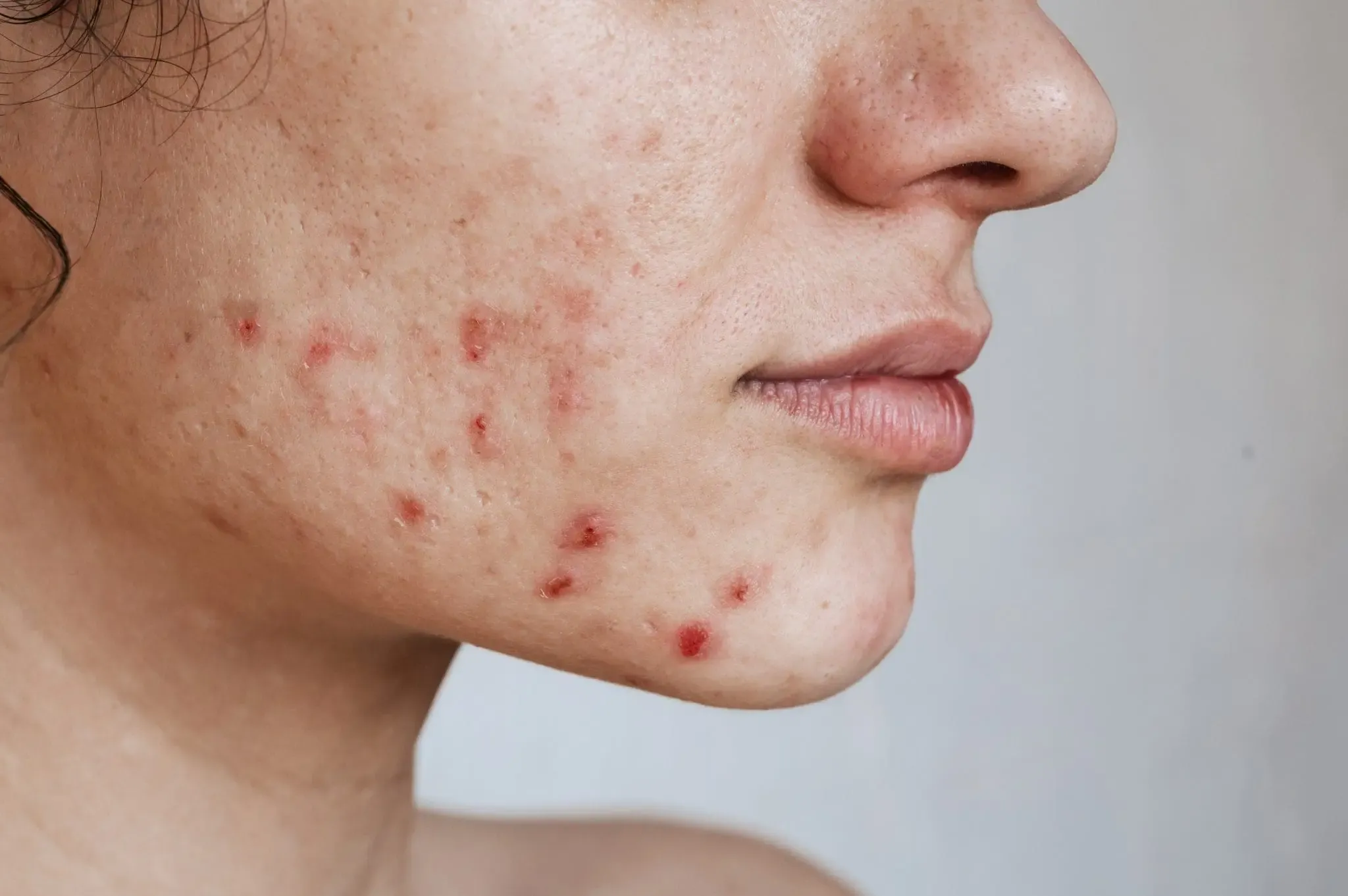 Etapas del acné y tratamiento dermatológico en Medellín para una piel sana