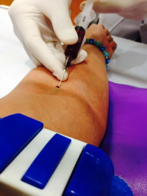 Oclusión de Venas con Radiofrecuencia en Medellín - especialistas certificados